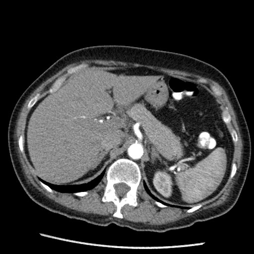 File:Amyloidosis - bronchial and diffuse nodular pulmonary involvement (Radiopaedia 60156-67745 A 54).jpg
