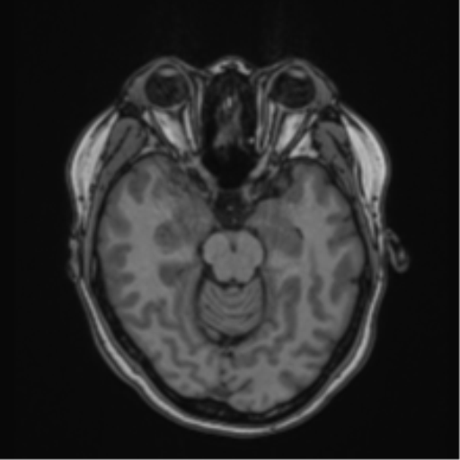 File:Anaplastic astroblastoma (Radiopaedia 55666-62194 Axial T1 28).png