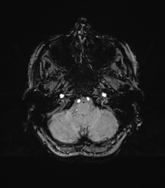 Anaplastic astrocytoma (Radiopaedia 86943-103160 Axial SWI 17).png