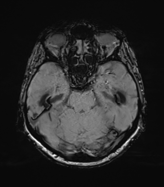 File:Anaplastic astrocytoma (Radiopaedia 86943-103160 Axial SWI 33).png