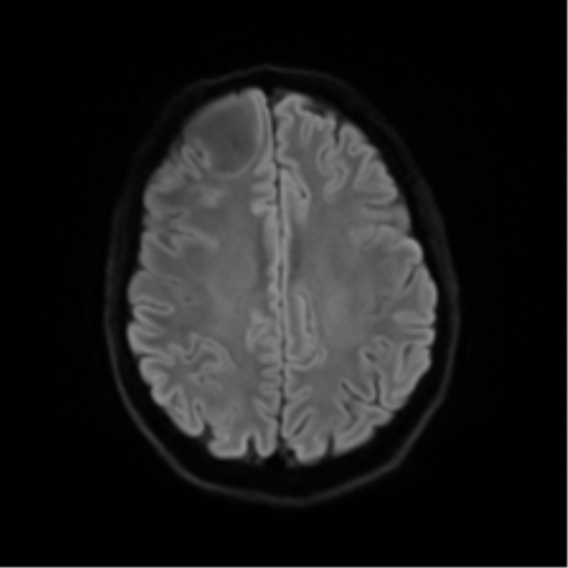 Anaplastic astrocytoma IDH mutant (Radiopaedia 50046-55341 Axial DWI 47).png
