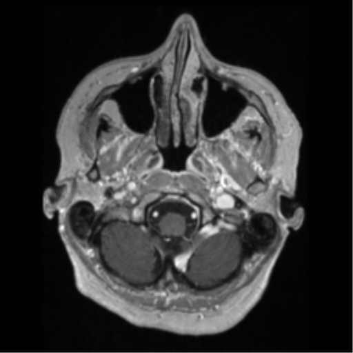 File:Anaplastic astrocytoma IDH wild-type (pseudoprogression) (Radiopaedia 42209-45276 Axial T1 C+ 23).png