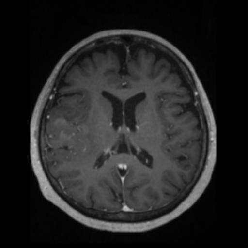 File:Anaplastic astrocytoma IDH wild-type (pseudoprogression) (Radiopaedia 42209-45276 Axial T1 C+ 87).png