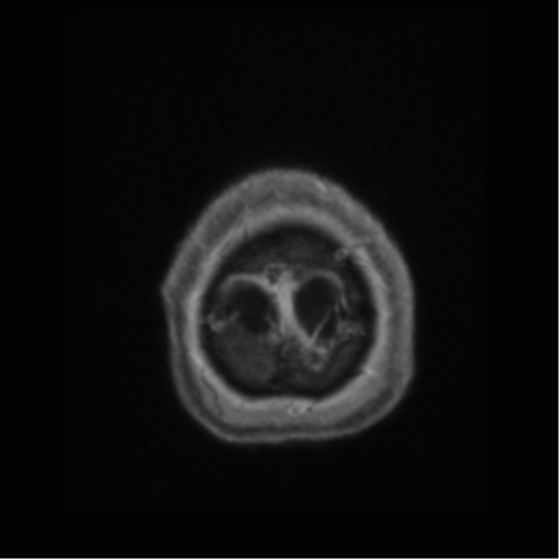 File:Anaplastic astrocytoma IDH wild-type (pseudoprogression) (Radiopaedia 42209-45277 Axial T1 C+ 127).png