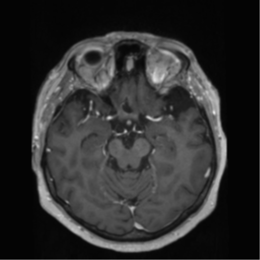 File:Anaplastic astrocytoma IDH wild-type (pseudoprogression) (Radiopaedia 42209-45278 Axial T1 C+ 66).png