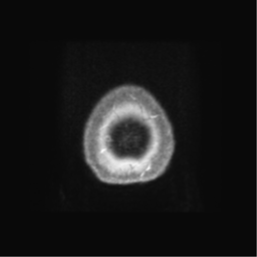 Anaplastic astrocytoma IDH wild-type (pseudoprogression) (Radiopaedia 42209-45279 Axial T1 C+ 143).png