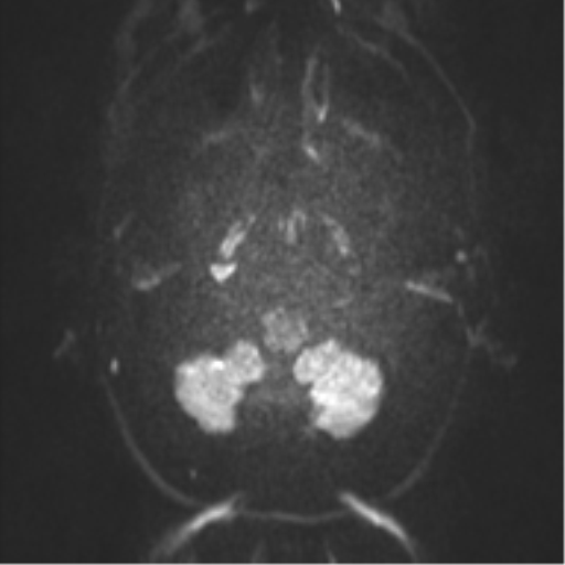 Anaplastic oligodendroglioma (Radiopaedia 37667-39563 Axial DWI 63).png