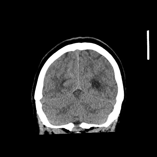 Aneursym related subarachnoid hemorrhage with hydrocephalus (Radiopaedia 45105-49083 Coronal non-contrast 53).jpg
