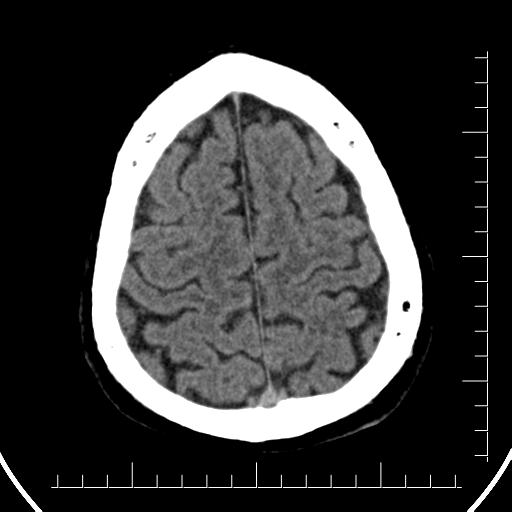 File:Aneurysm of posterior communicating artery (Radiopaedia 20188-20162 Axial non-contrast 40).jpg