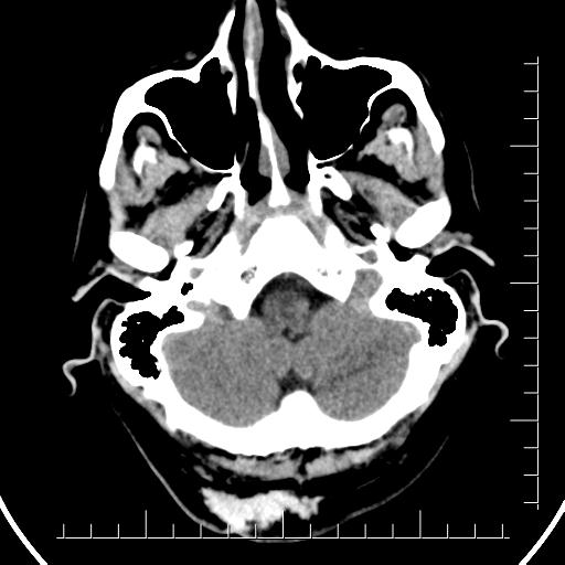 File:Aneurysm of posterior communicating artery (Radiopaedia 20188-20162 Axial non-contrast 7).jpg
