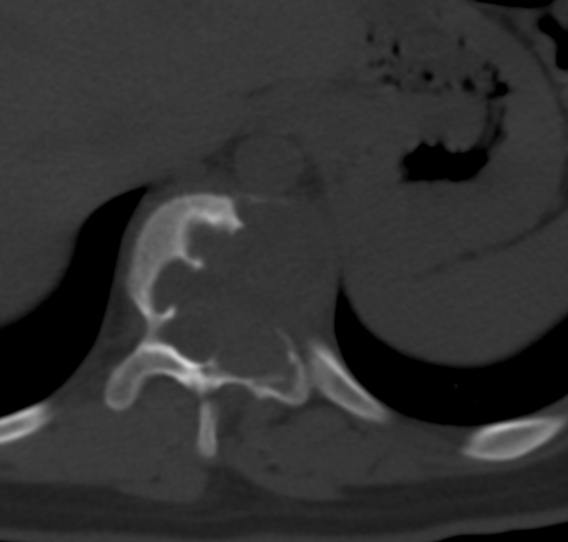 File:Aneurysmal bone cyst (Radiopaedia 9419-10102 Axial bone window 1).jpg