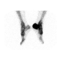 File:Aneurysmal bone cyst of the calcaneus (Radiopaedia 60669-68419 LAO 1).jpg