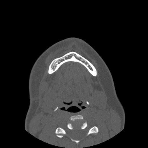 Aneurysmal bone cyst of the mandible (Radiopaedia 43280-46823 Axial bone window 21).jpg