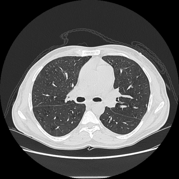 Angioinvasive aspergellosis (Radiopaedia 66995-76315 Axial lung window 22).jpg