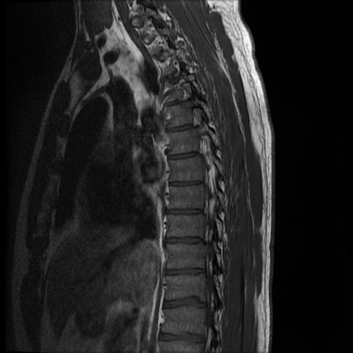 File:Angiolipoma - thoracic spine (Radiopaedia 28242-28479 Sagittal T1 10).jpg