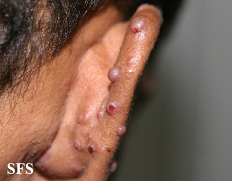 Angiolymphoid Hyperplasia With Eosinophilia (Dermatology Atlas 7).jpg