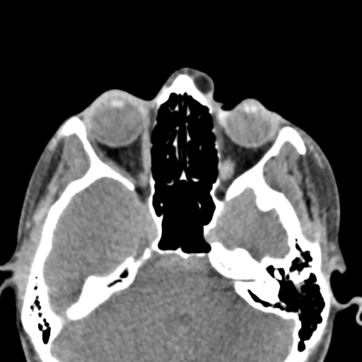 Angular dermoid cyst (Radiopaedia 88967-105790 Axial non-contrast 26).jpg
