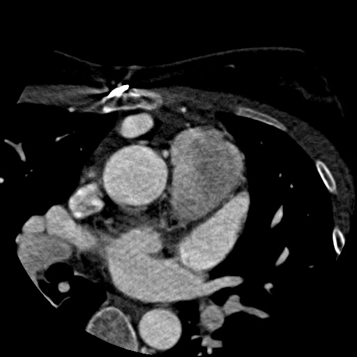 File:Anomalous left coronary artery from the pulmonary artery (ALCAPA) (Radiopaedia 40884-43586 A 10).jpg