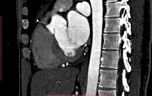 File:Anomalous left coronary artery from the pulmonary artery (ALCAPA) (Radiopaedia 70148-80181 C 124).jpg
