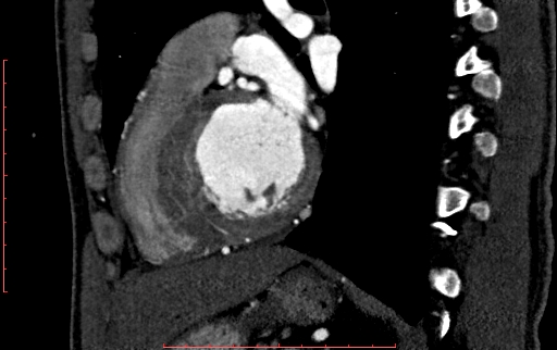 Anomalous left coronary artery from the pulmonary artery (ALCAPA) (Radiopaedia 70148-80181 C 161).jpg