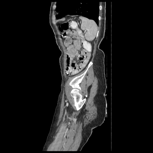 Anorectal carcinoma (Radiopaedia 44413-48064 C 94).jpg
