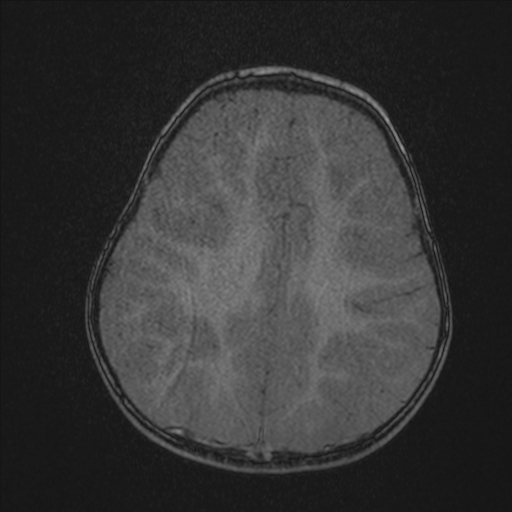 Anoxic brain injury (Radiopaedia 79165-92139 Axial MRA 181).jpg