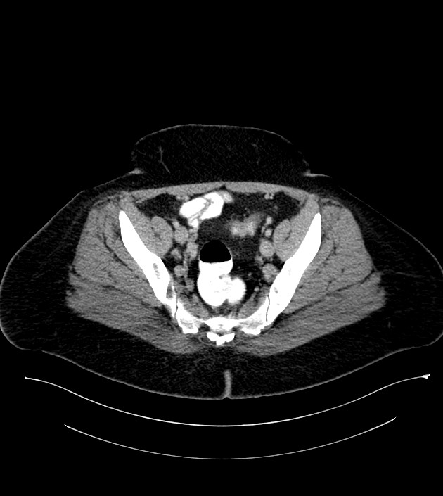 Anterior abdominal wall CSF pseudocyst (CSFoma) (Radiopaedia 79453-92571 A 76).jpg