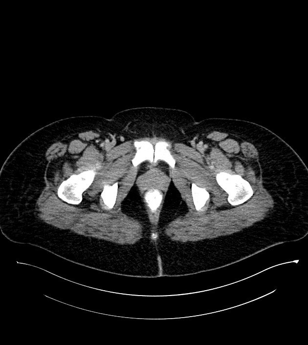 Anterior abdominal wall CSF pseudocyst (CSFoma) (Radiopaedia 79453-92571 A 93).jpg