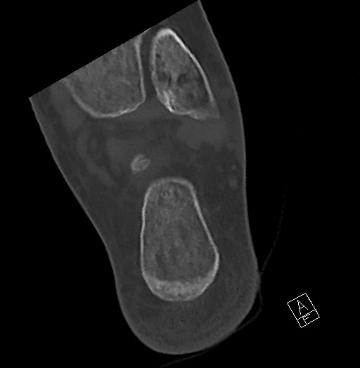Anterior calcaneal process fracture (Radiopaedia 63353-71943 Axial bone window 115).jpg