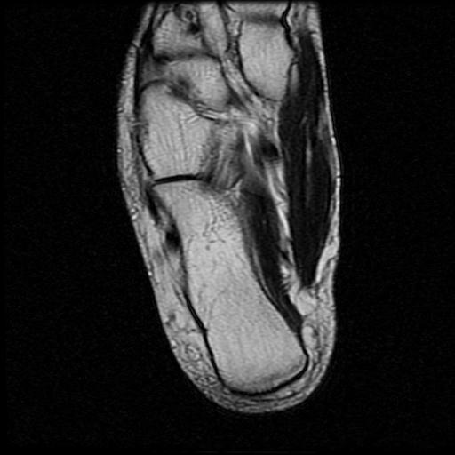 File:Anterior calcaneal process fracture (Radiopaedia 71377-81705 Axial T2 14).jpg