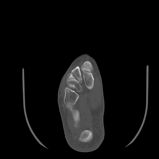 Anterior calcaneal process fracture (Radiopaedia 82590-96762 Axial bone window 29).jpg