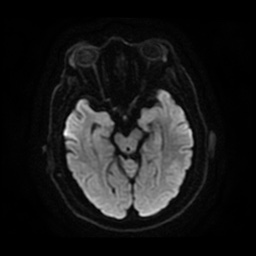 Anterior cerebral artery infarction (Radiopaedia 46794-51323 Axial DWI 12).jpg