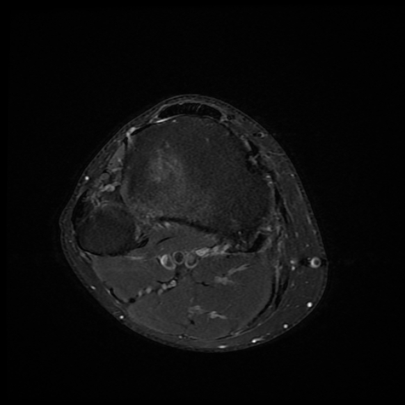 File:Anterior cruciate ligament graft tear and bucket-handle tear of medial meniscus (Radiopaedia 75867-87254 Axial PD fat sat 3).jpg