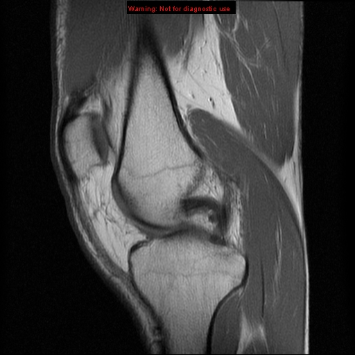 File:Anterior cruciate ligament injury - partial thickness tear (Radiopaedia 12176-12515 Sagittal PD 8).jpg