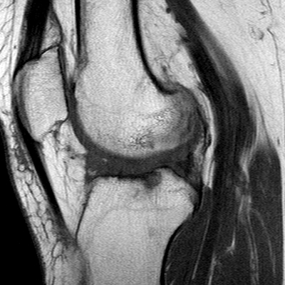 Anterior cruciate ligament mucoid degeneration (Radiopaedia 60853-68633 Sagittal T1 16).jpg