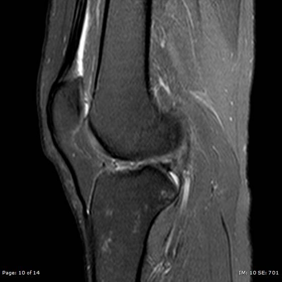 File:Anterior cruciate ligament tear (Radiopaedia 70783-80964 Sagittal PD fat sat 10).jpg