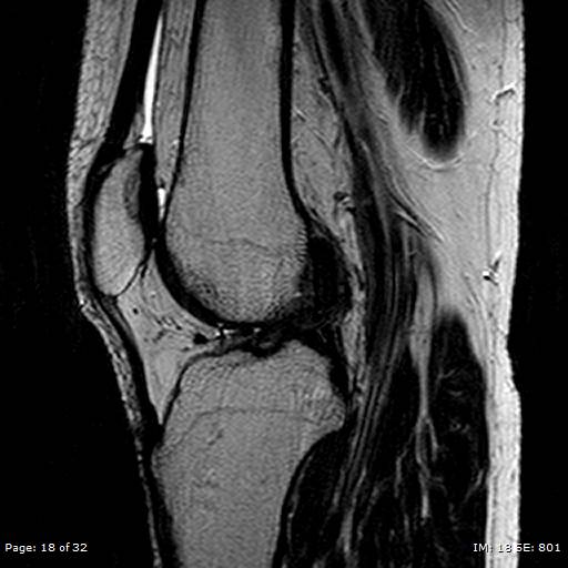 File:Anterior cruciate ligament tear (Radiopaedia 70783-80964 Sagittal T2 18).jpg