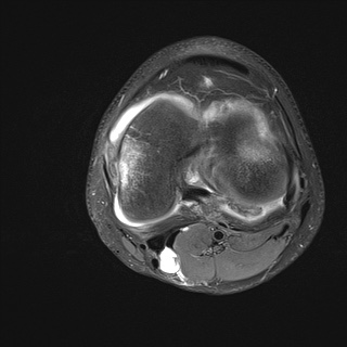 File:Anterior cruciate ligament tear - pediatric (Radiopaedia 62152-70260 Axial PD fat sat 22).jpg