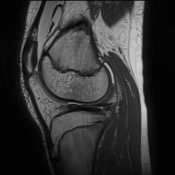 Anterior cruciate ligament tear - pediatric (Radiopaedia 62152-70260 Sagittal PD 116).jpg