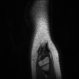 Anterior cruciate ligament tear - pediatric (Radiopaedia 62152-70260 Sagittal PD 165).jpg