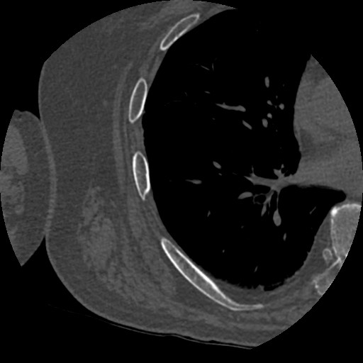 File:Anterior glenohumeral dislocation with Hill-Sachs lesion (Radiopaedia 62877-71249 Axial bone window 109).jpg