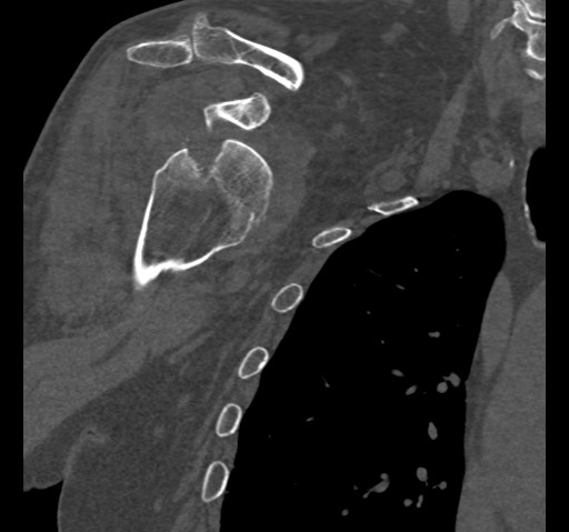 Anterior glenohumeral dislocation with Hill-Sachs lesion (Radiopaedia 62877-71249 Coronal bone window 34).jpg