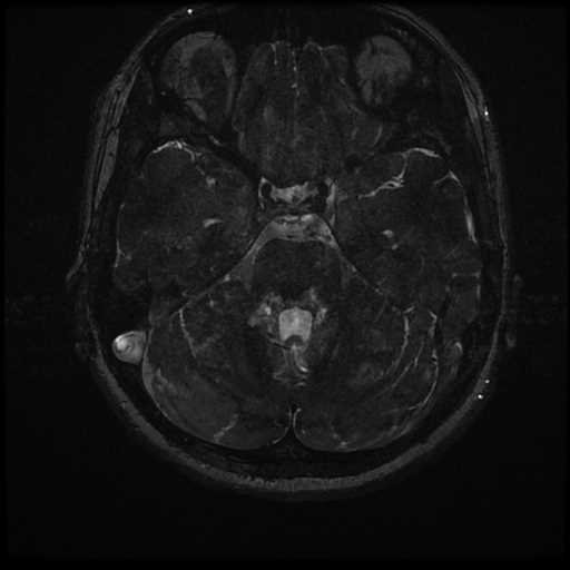Anterior inferior cerebellar artery vascular loop - type II (Radiopaedia 70991-81209 Axial 3D FIESTA 6).jpg