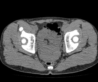 File:Anterior inferior iliac spine avulsion fracture (Radiopaedia 81312-94999 Axial non-contrast 50).jpg