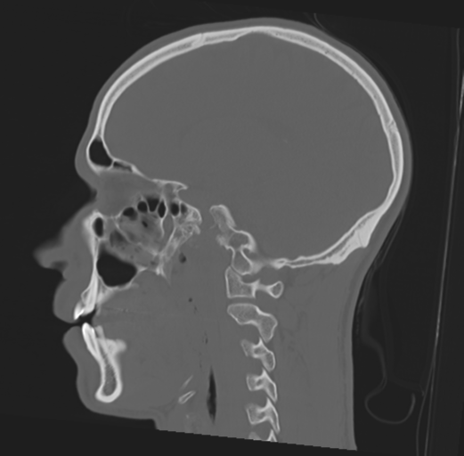 Anterior nasal spine fracture (Radiopaedia 46138-50494 Sagittal bone window 24).png