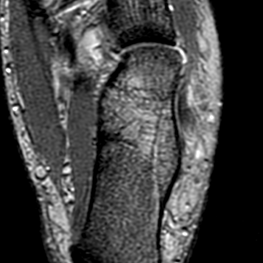 File:Anterior talofibular ligament rupture (Radiopaedia 15831-15484 Axial T2* 20).jpg