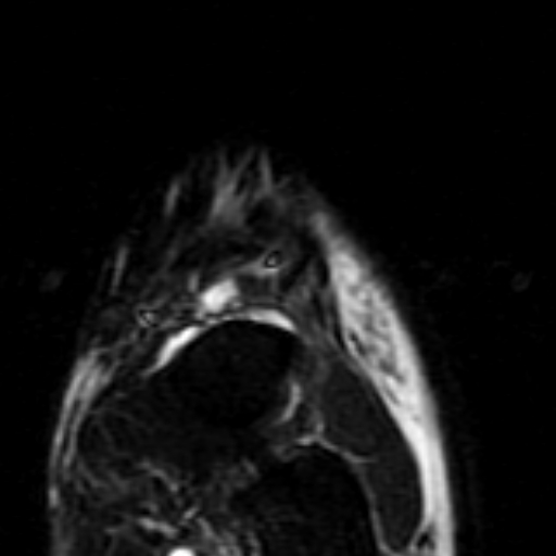File:Anterior talofibular ligament rupture (Radiopaedia 15831-15484 Coronal STIR 2).jpg