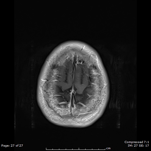 File:Anterior temporal lobe perivascular space (Radiopaedia 88283-104914 Axial T1 C+ 27).jpg