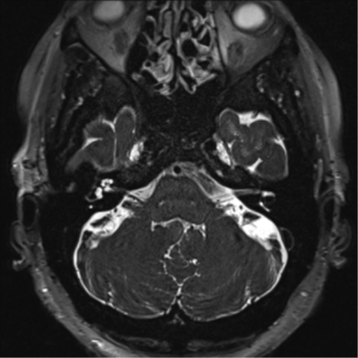 File:Anterior temporal pole cysts (Radiopaedia 46629-51102 Axial 1).png