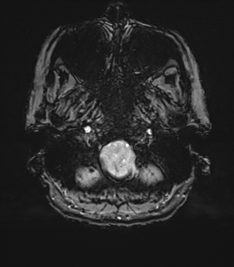 Anterior temporal pole cysts (Radiopaedia 46629-51102 Axial SWI 11).png